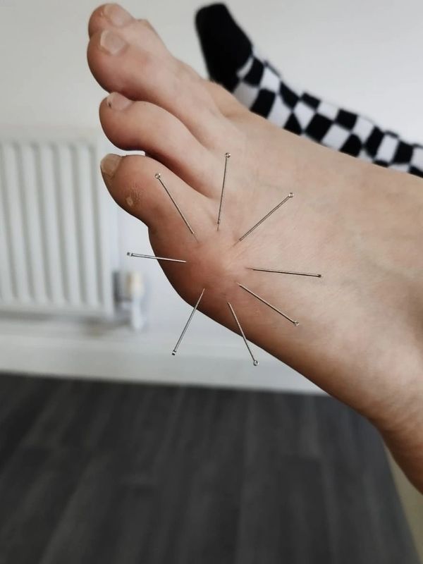 acupuncture on bunion