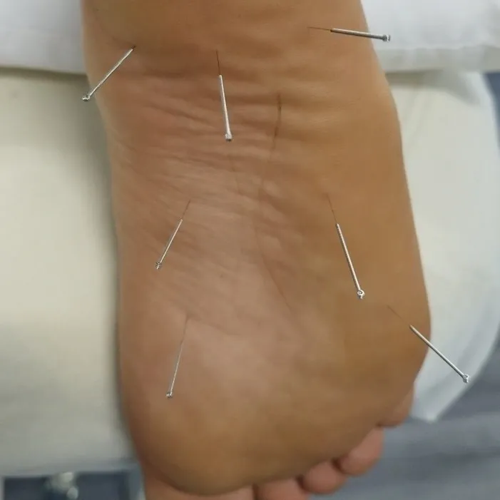 acupuncture under feet