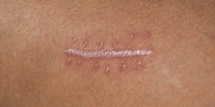 treatment scar